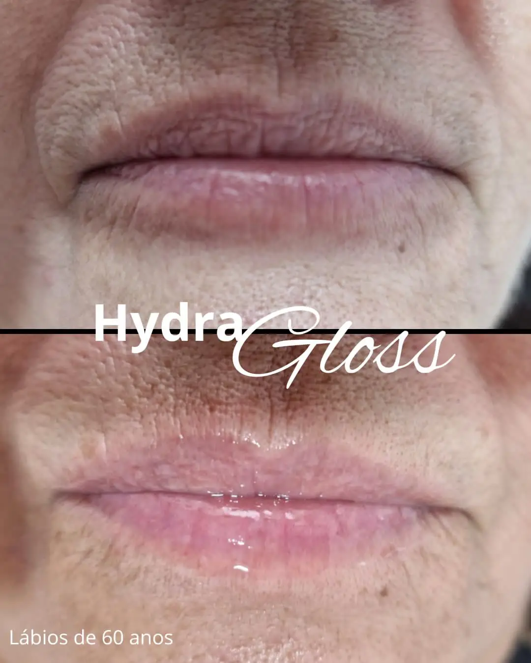 Onde fazer Hidra Gloss no Centro de Içara - SC | Clinica Estética Athena