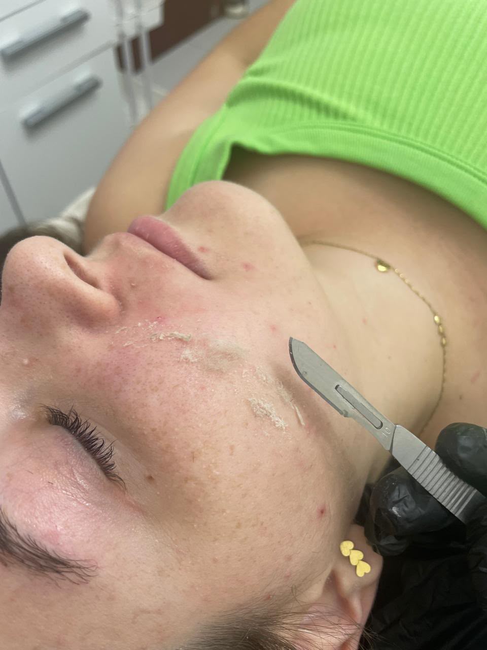 Dermaplaning no Centro de Içara | Clinica Estética Athena